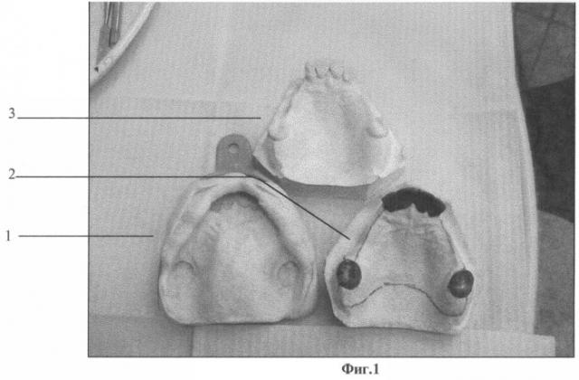 Способ изготовления несъемных и съемных временных протезов (патент 2271772)
