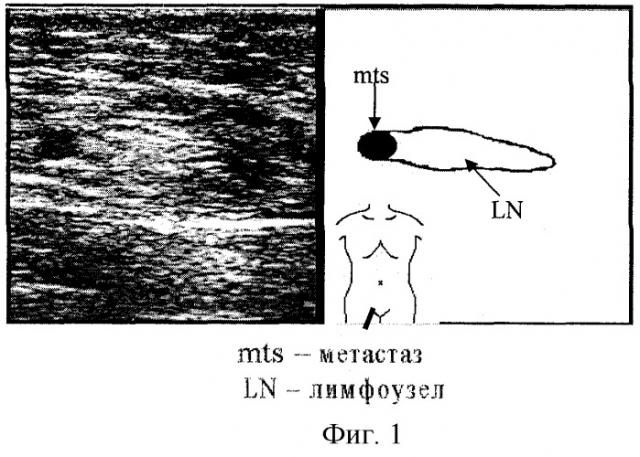 Способ ультразвуковой диагностики метастатического поражения регионарных лимфатических узлов (патент 2284754)