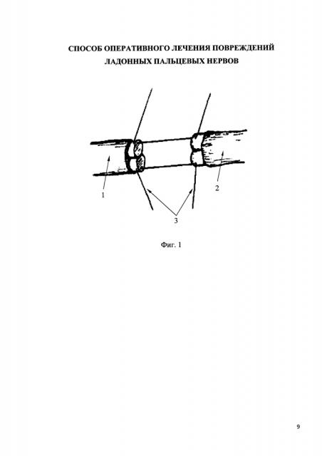 Способ оперативного лечения повреждений ладонных пальцевых нервов (патент 2612122)