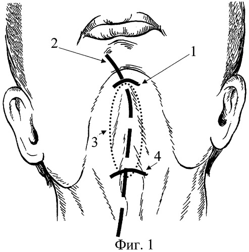 Способ лечения флегмоны дна полости рта (патент 2284765)
