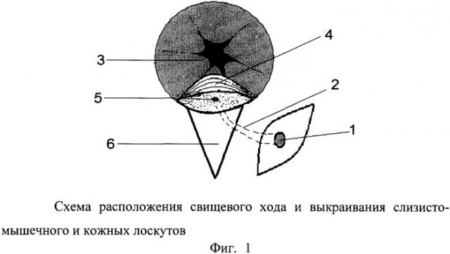 Способ лечения экстрасфинктерного параректального свища (патент 2328983)