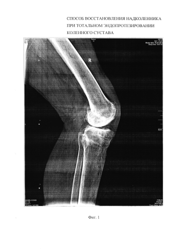Способ восстановления надколенника при тотальном эндопротезировании коленного сустава (патент 2592025)