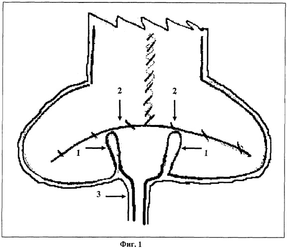 Способ формирования ортотопического мочевого резервуара (патент 2264790)