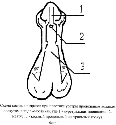 Способ формирования кожного лоскута при пластике уретры по поводу "дистальной" гипоспадии по кравцову ю.а. - i (патент 2454945)