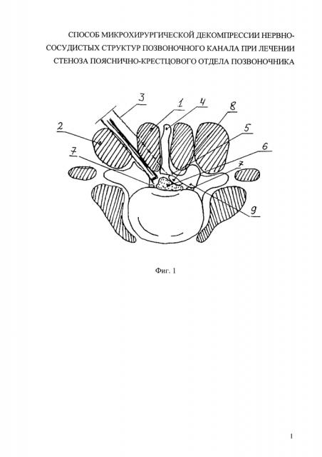 Способ микрохирургической декомпрессии нервно-сосудистых структур позвоночного канала при лечении стеноза пояснично-крестцового отдела позвоночника (патент 2628653)