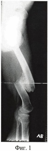 Способ лечения больных с застарелыми, неправильно сросшимися переломами бедренной кости (патент 2445032)