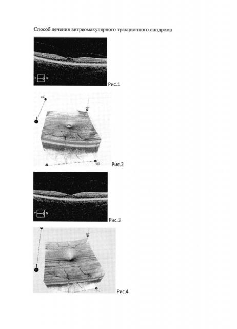 Способ лечения витреомакулярного тракционного синдрома (патент 2619991)