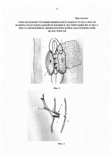 Способ реконструкции пищеварительного тракта после панкреатодуоденальной резекции и экстирпации желудка с восстановлением физиологической и анатомической целостности (патент 2636881)