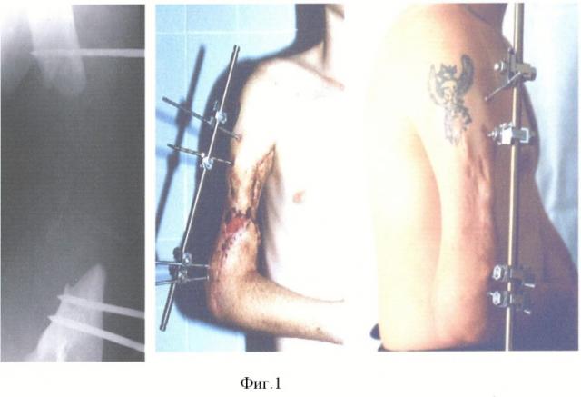 Способ пластики сложных дефектов плеча после огнестрельных ранений с обширным разрушением плечевой кости и мягких тканей (патент 2371136)