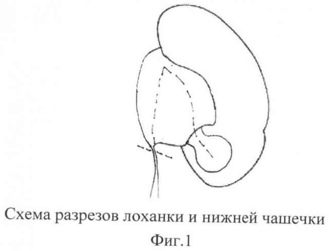 Способ лечения гидронефроза у детей (патент 2495630)