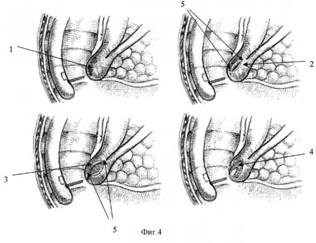 Способ нетипичной эндоскопической папиллотомии (патент 2258480)