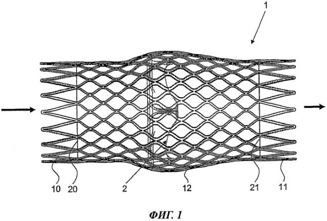 Стент, снабженный клапаном сосуда (патент 2469681)