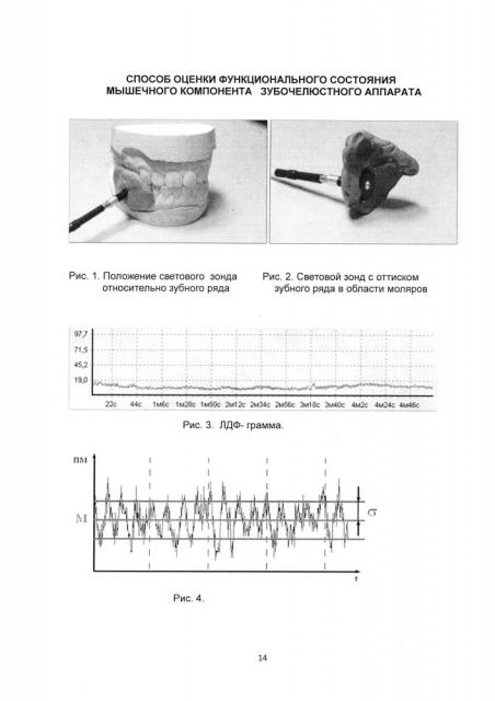 Способ оценки функционального состояния мышечного компонента зубочелюстного аппарата (патент 2616179)