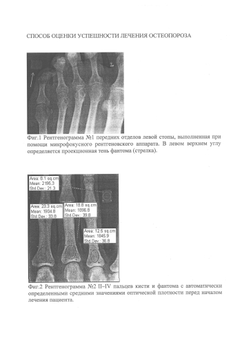Способ оценки успешности лечения остеопороза (патент 2585403)