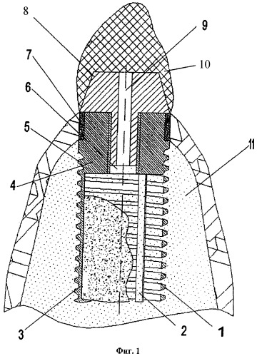 Зубной имплантат (патент 2407479)