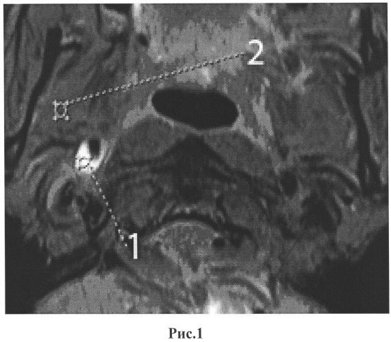Способ дифференциальной диагностики диссекции с формированием интрамуральной гематомы и внутриартериального тромбоза внутренних сонных артерий (патент 2526267)