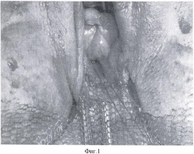 Способ хирургического лечения опущения и/или выпадения стенок влагалища у женщин после экстирпации матки (патент 2476175)