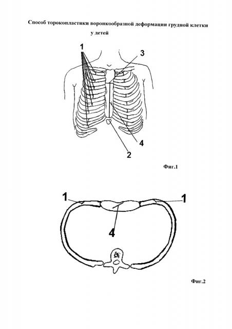 Способ торокопластики воронкообразной деформации грудной клетки (патент 2653264)