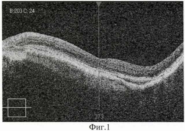 Способ ранней доклинической диагностики прогрессирования эпиретинальной мембраны у пациентов с высокой миопией (патент 2407444)