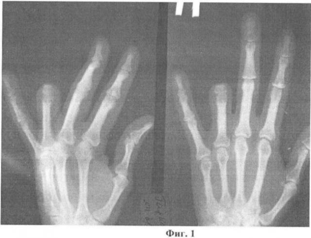 Способ кожно-костной реконструкции пальца кисти (патент 2482803)