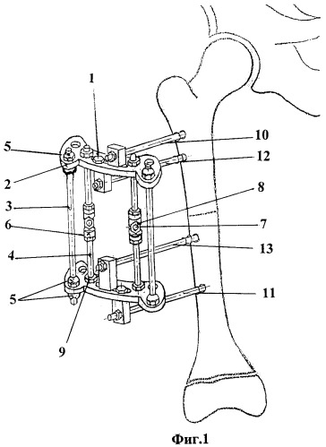 Устройство для удлинения бедренной кости с одновременным восстановлением биомеханической оси конечности (патент 2452419)