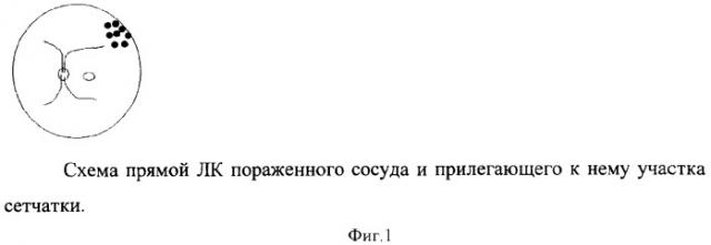 Способ лечения экссудативной макулопатии у больных с ретинитом коатса (патент 2371152)