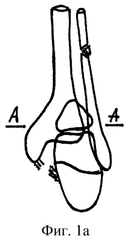 Способ артродеза голеностопного сустава при неправильно сросшихся переломах малоберцовой кости и заднего края большеберцовой кости (патент 2243737)