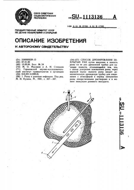Способ дренирования закрытых ран (патент 1113136)
