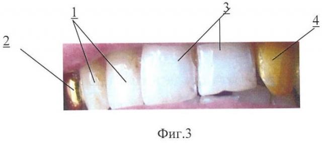 Средство для окрашивания зубов (патент 2429814)