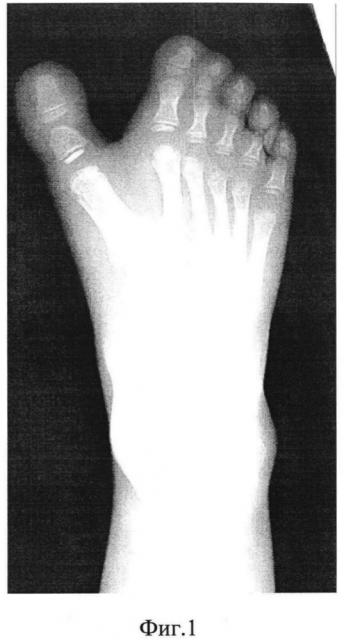 Способ лечения полидактилии при наличии шести нормально развитых лучей стопы (патент 2645125)