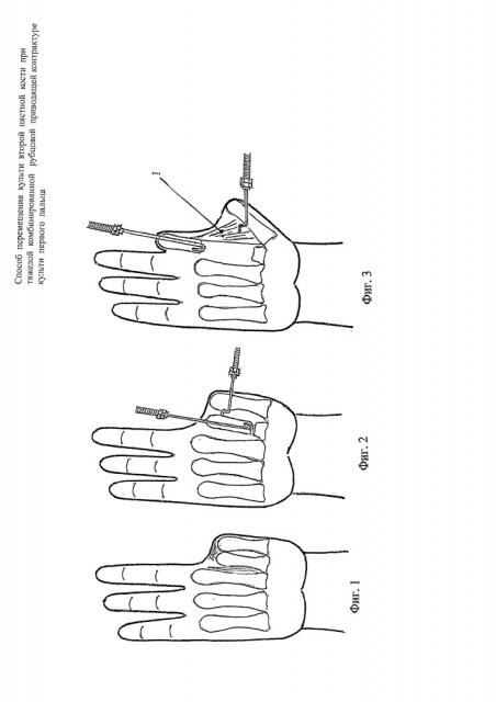 Способ перемещения культи второй пястной кости при тяжелой комбинированной рубцовой приводящей контрактуре культи первого пальца (патент 2662649)