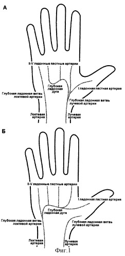 Способ диагностики анатомического типа кровоснабжения кисти (патент 2261658)