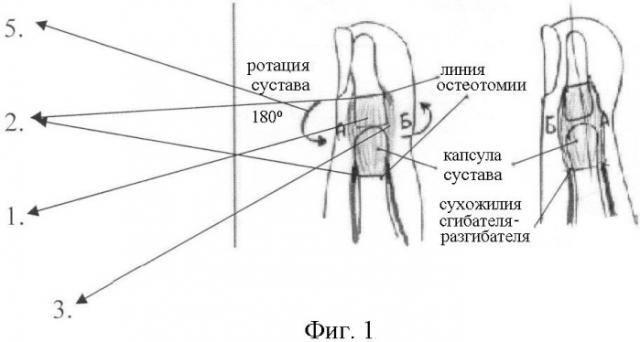 Способ формирования подвижности в суставе пальца при подготовке к протезированию (патент 2391067)