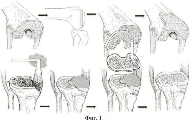 Способ замещения костных дефектов мыщелков большеберцовой или бедренной костей при тотальном эндопротезировании коленного сустава (патент 2465855)