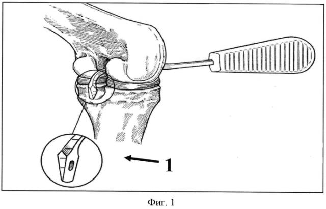 Способ артроскопической реконструкции задней крестообразной связки и набор инструментов для защиты подколенной артерии при его выполнении (патент 2557426)
