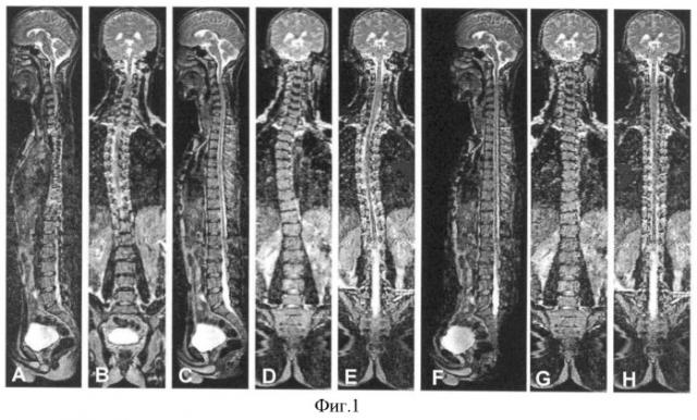 Способ визуализации позвоночника методом магнитно-резонансной томографии (патент 2368313)