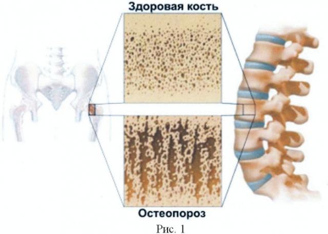 Способ заполнения полостных образований в метафизарных (трабекулярных) участках костей кальцием и предотвращения выведения из них кальция (патент 2466732)