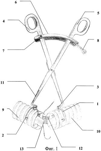 Способ наложения трахеотрахеального анастомоза (патент 2309686)