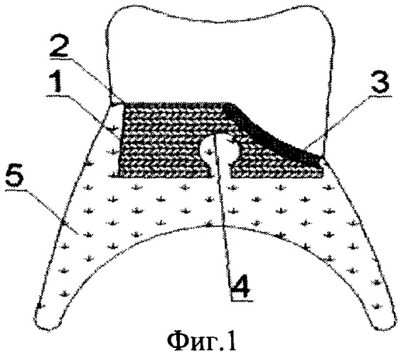 способ подготовки искусственных пластмассовых зубов для фиксации в базисе нейлонового протеза (патент 2362508)