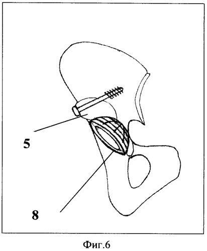 Способ эндопротезирования тазобедренного сустава при костном дефекте вертлужной впадины (патент 2475202)