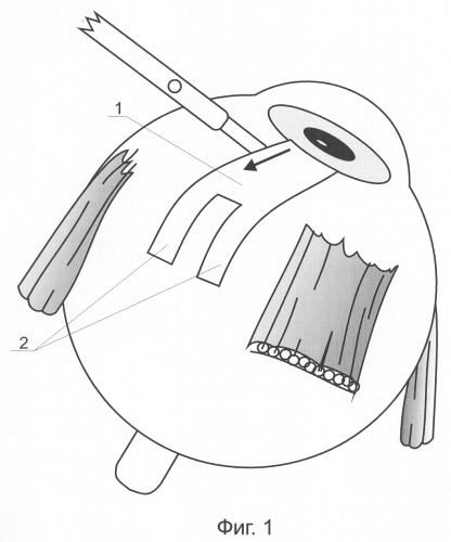 Способ хирургического лечения глаукомы (патент 2290149)