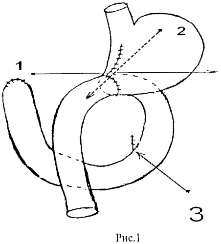 Способ формирования гастроэнтероанастомоза (патент 2533029)