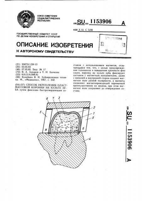 Способ укрепления пластмассовой коронки на культе зуба (патент 1153906)