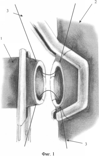Способ формирования анастомоза на магистральных сосудах (патент 2329772)