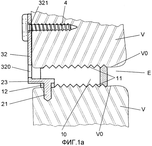 Позвоночное разделительное устройство с модульным креплением (патент 2344792)