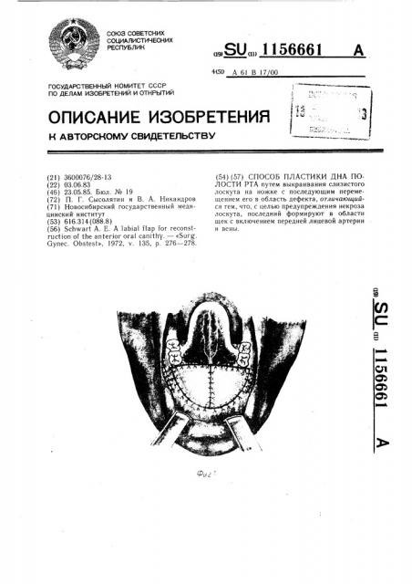 Способ пластики дна полости рта (патент 1156661)