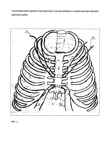 Способ фиксации переднего флотирующего грудино-реберного клапана при двусторонних переломах ребер (патент 2621871)
