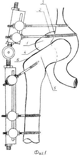 Способ артродеза тазобедренного сустава (патент 2300334)