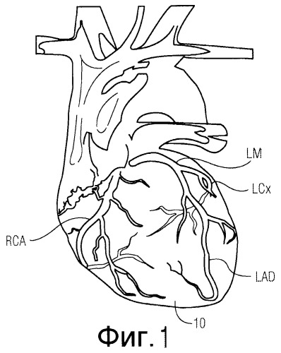 Автоматическая идентификация инфаркт-зависимой коронарной артерии путем анатомически ориентированного отображения на дисплее данных экг (патент 2512931)