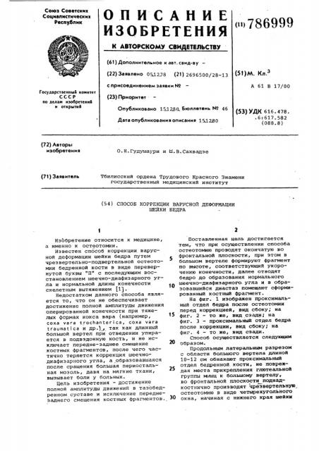 Способ коррекции варусной деформации шейки бедра (патент 786999)